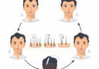 FUE زراعة الشعر بتقنية