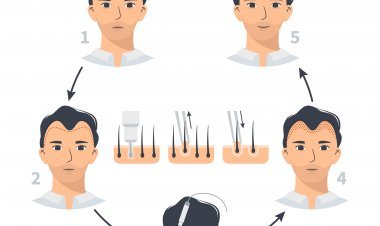Hair Transplant with FUE Technique