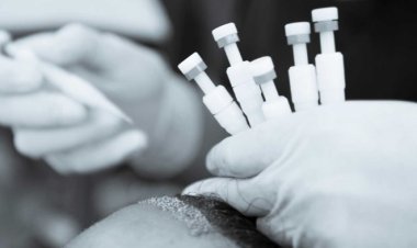 DHI - (Direct Hair Implant) Hair Transplant