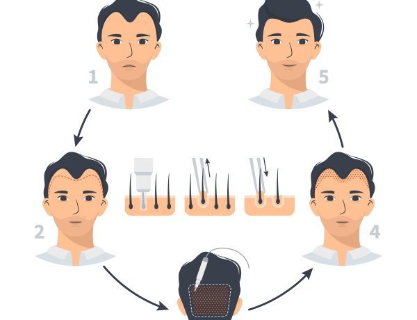FUE زراعة الشعر بتقنية