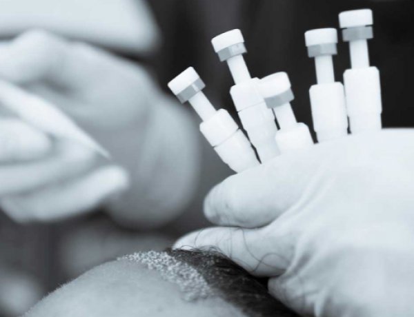 DHİ زراعة الشعر بتقنية