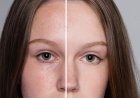 Thread Lifting (whole face)