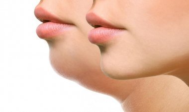 Submental Liposuction