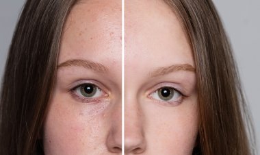 Thread Lifting (whole face)